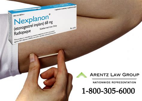 Nexplanon Lawyers