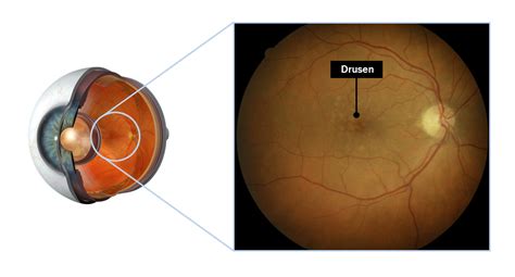 Macular Degeneration – Eye Doctors Mona Vale