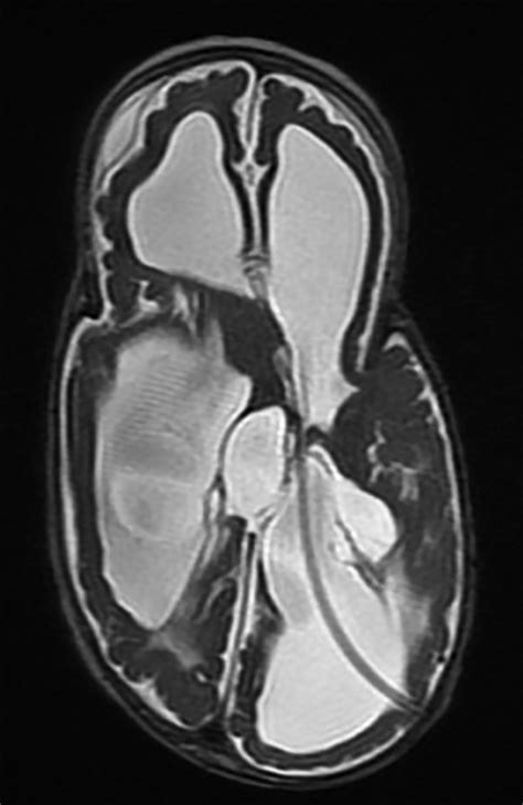 Advances in the evaluation and management of cortical/cerebral visual ...