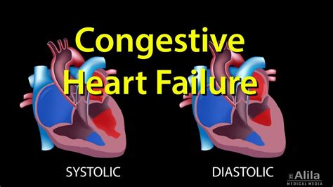 Heart Failure Cartoon - Cartoons Failure Congestive Cardiology | Liferisife