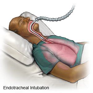 Endotracheal Tube - What You Need to Know