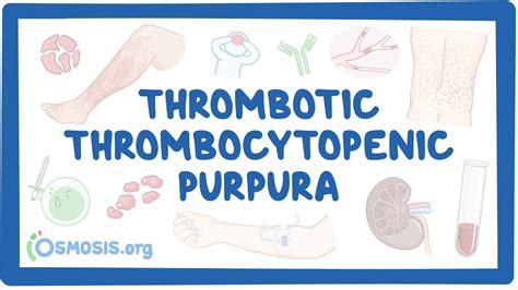 Thrombotic Thrombocytopenic Purpura Symptoms, Causes,, 47% OFF