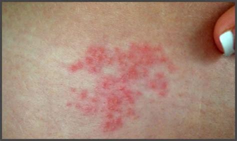 Shingles pictures early stages | Shingles Expert