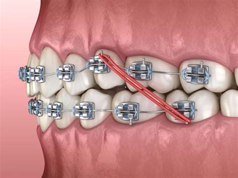 Corrective Braces For an Overjet - Henry Orthodontics Pinehurst, North ...