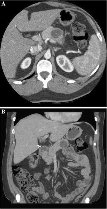 Abdominal CT with pancreatic protocol showing cystic pancreatic mass. a ...