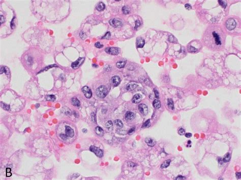 Cureus | Metastatic Pleural Effusion: An Unusual Presentation of ...