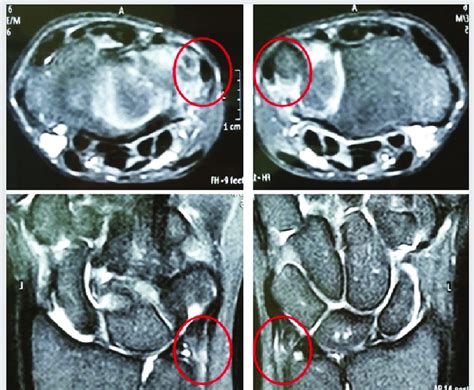 Wrist magnetic resonance imaging. Bilateral extensor carpi ulnaris ...