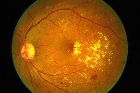 Moderate Diabetic Retinopathy