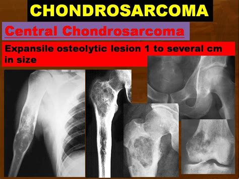 TODAYS LONG TOPIC "CHONDROSARCOMA".... - Radiology Classroom | Facebook