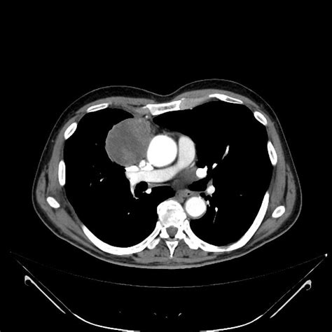 Thymoma - smooth anterior mediastinal mass, with mixed internal density ...