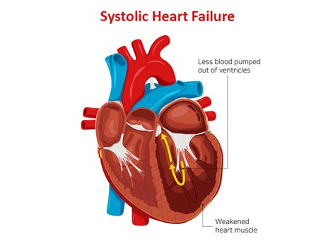 What ar Systolic Heart Failure Symptoms and Treatment | Dr. Raghu