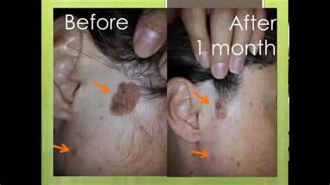 seborrheic keratosis images - pictures, photos