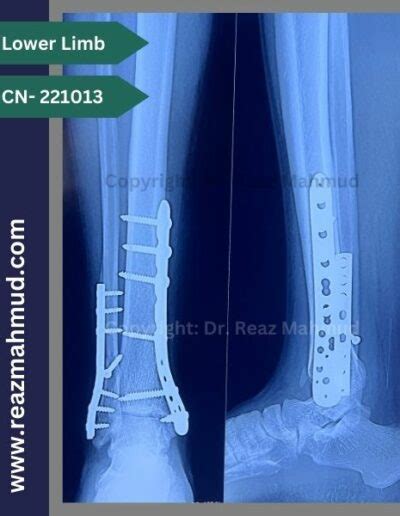 Bimalleolar Fracture | ORIF [221013] - Dr. Reaz Mahmud