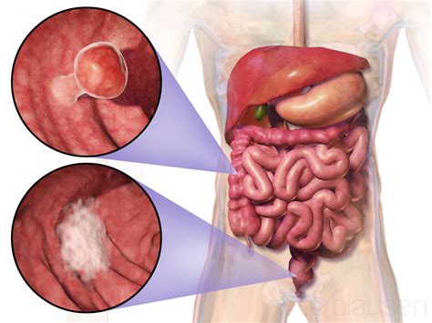 Carcinoma del colon-retto - Wikipedia