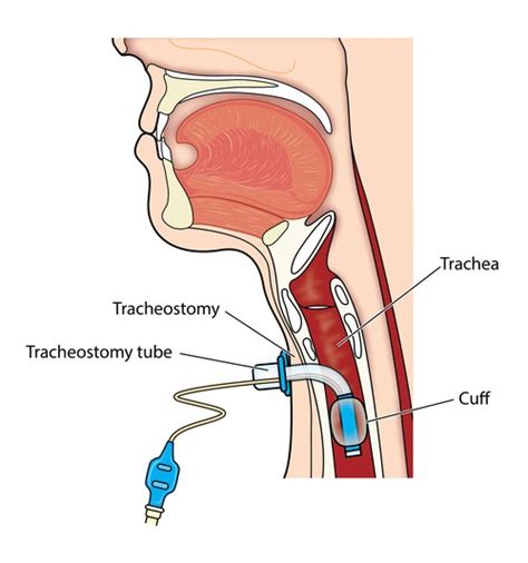 Tracheostomy