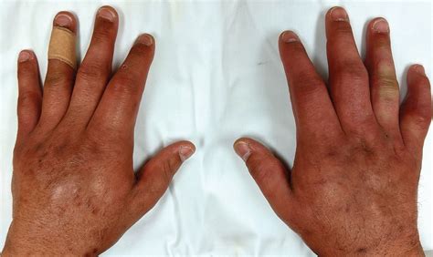 Puffy hand syndrome | Cleveland Clinic Journal of Medicine