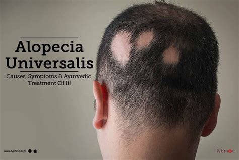 Alopecia Universalis - Causes, Symptoms & Ayurvedic Treatment Of It ...