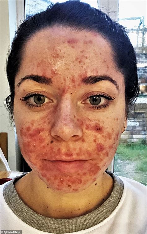 Personal trainer shares her striking before and after acne pictures ...