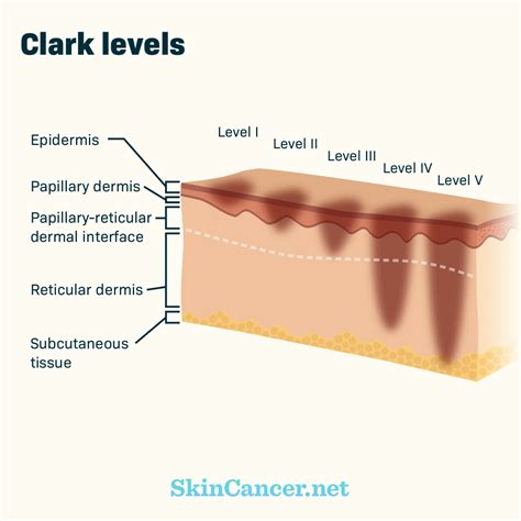 A Breakdown of the Stages of Melanoma