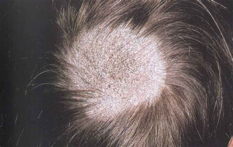 Tinea Capitis How Can Ayurveda Treat Your Scalp Condition?, 55% OFF