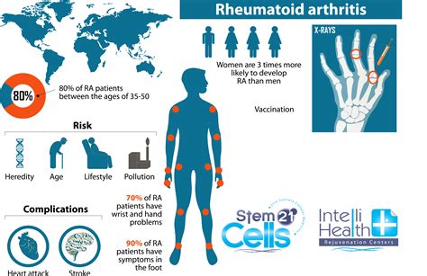 Rheumatoid Arthritis Treatments | Stem Cells 21