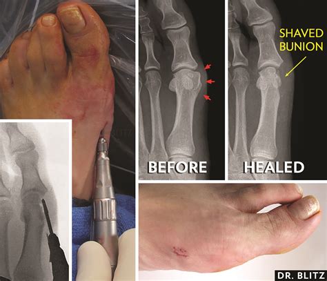 Current Concepts In Minimally Invasive Bunion Surgery