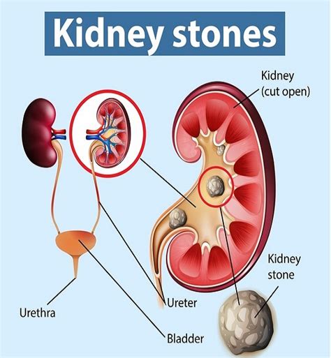 What is the best way to relieve kidney stone pain?