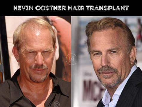 Kevin Costner Hair Transplant - Hair Loss & Technical Analysis