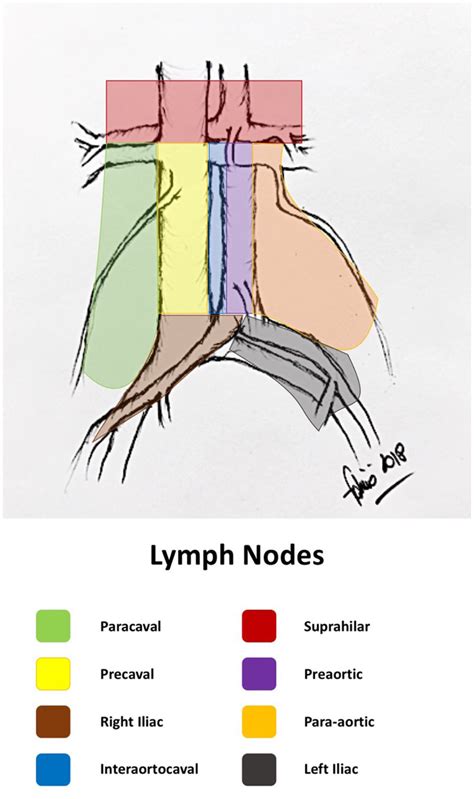 | Retroperitoneal lymph node areas (original drawing by the author ...