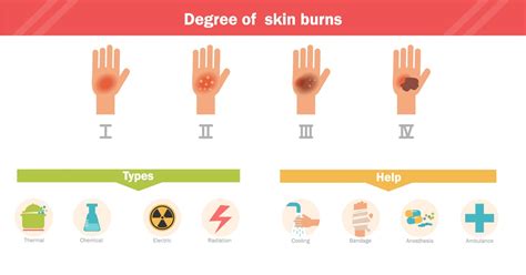 What Are Burn Injury Categories? | FAQ | Viles & Beckman, LLC