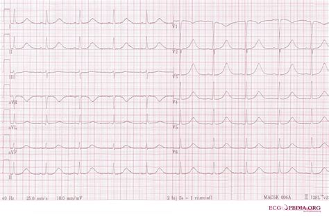 Long QT Syndrome electrocardiogram - wikidoc