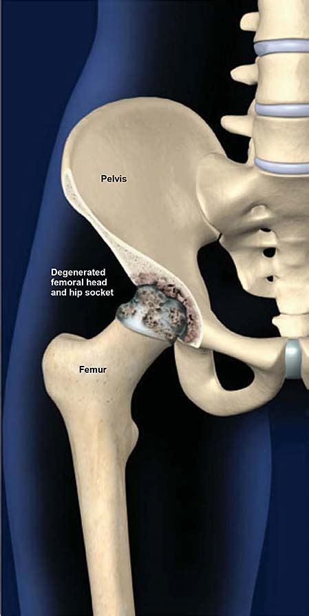 Degenerative Joint Disease of the Hip (Osteoarthritis of the Hip ...