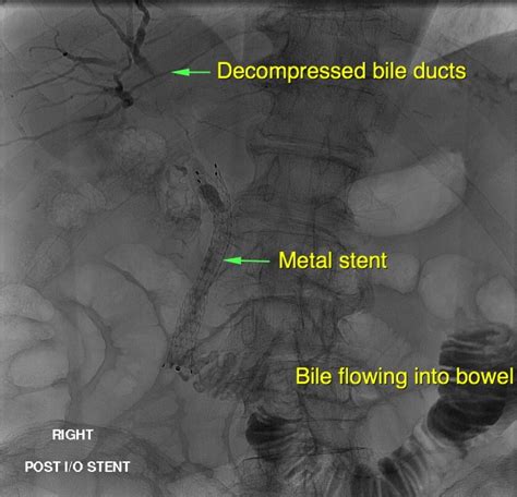 Blocked Bile Ducts - PTC | Sydney Medical Interventions