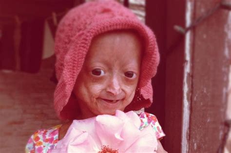 Progeria Baby - Viewing Gallery