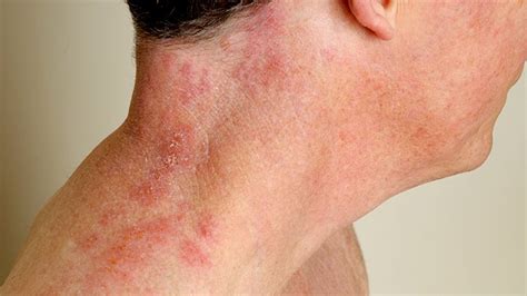 Tips to Treat Shingles Scalp pain and itchy rash | Everyday Health