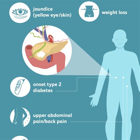 Pancreatic Cancer: Signs, Symptoms, and Complications