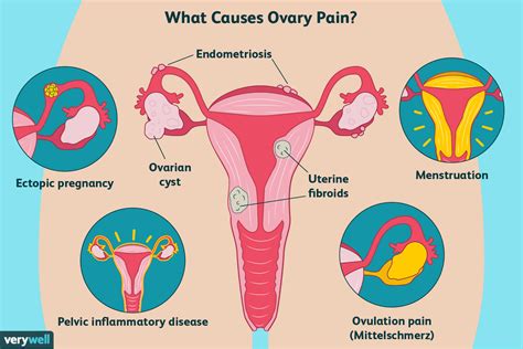 Ovary Pain: 12 Possible Causes