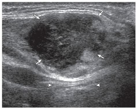 Neck Lipoma Ultrasound Images - Infoupdate.org