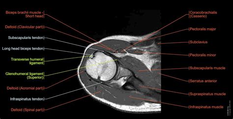 Shoulder MRI: normal anatomy | e-Anatomy