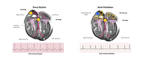 AV Node Ablation - One Heart Cardiology