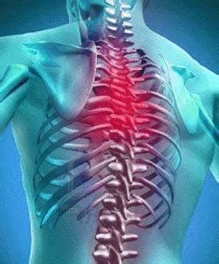 Thoracic Herniated Disc - How Disc Herniation Occurs - Recovery