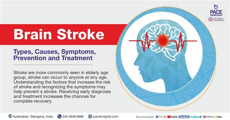 Brain Stroke: Types, Causes, Symptoms, Prevention and Treatment