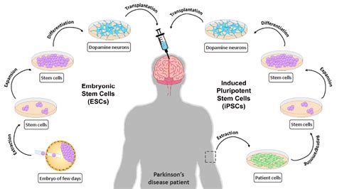 Stem cell therapy for Parkinson’s disease | Atlas of Science