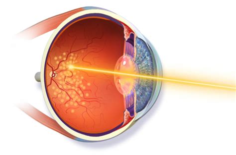 Damaged Retina Treatment: Surgical Methods & Care- EyeMantra