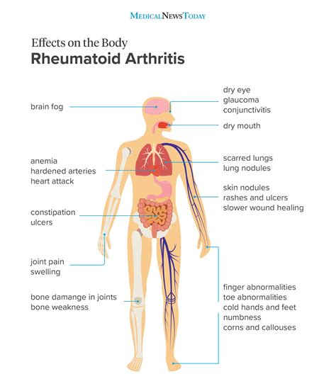 Rheumatoid In Hindi - werohmedia