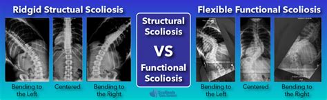 What is Scoliosis? Scoliosis Defined & Its Causes - Scoliosis Care Centers