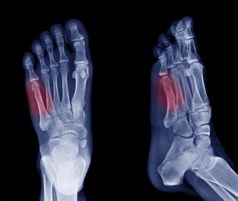 Jones fracture: Causes, symptoms, and treatment