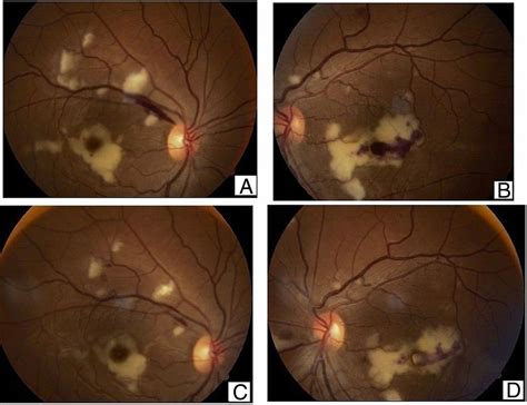 Purtscher's-like retinopathy in acute alcoholic pancreatitis | BMJ Case ...