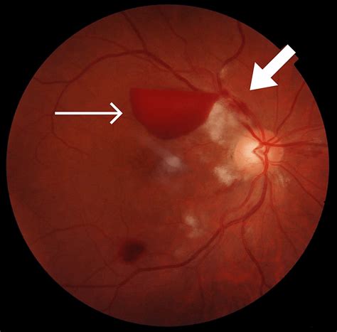 Purtscher Retinopathy Following Compressive Chest Trauma: A Case Report ...