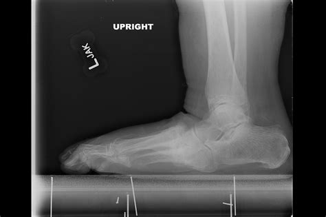 Ortho Dx: Severe Charcot Arthropathy - Clinical Advisor